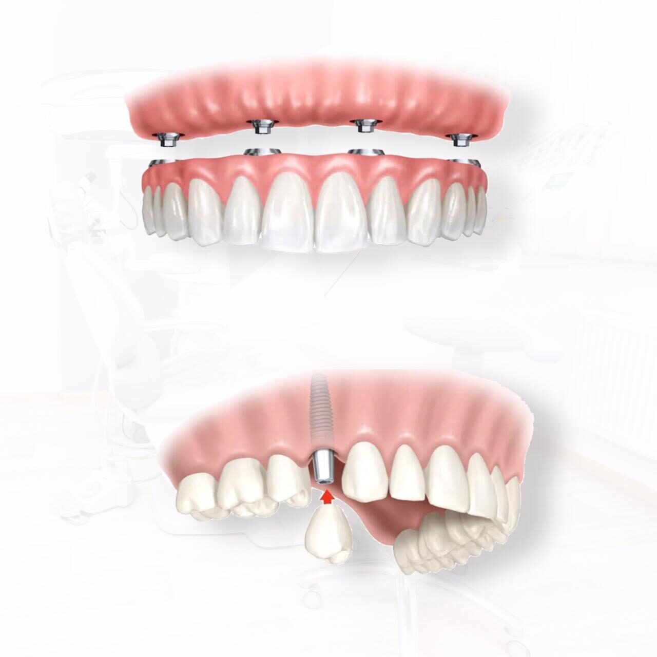 sorria-mais-aqui-botoes-implantes